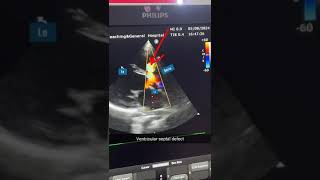 Subaortic VSDLeft to Right shuntPerimembranous VSDAcynotic congenital heart disease MRMC [upl. by Olecram]