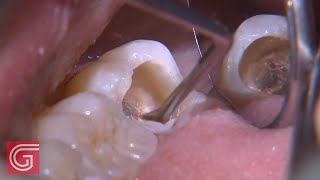 HOW TO Clean Up Severe Occlusal Decay on TOOTH 31 1 of 2 [upl. by Tarra860]