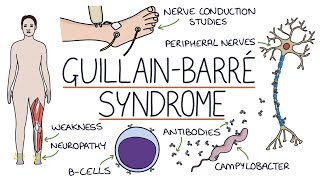 Understanding GuillainBarré Syndrome [upl. by Kcered563]