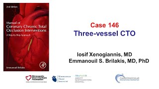 Case 146 Manual of CTO PCI  3 CTOs and multiple complications [upl. by Rehm]