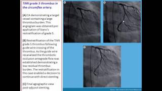 Thrombus containing lesions [upl. by Bunns207]