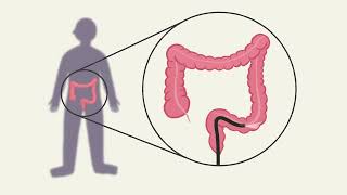 Colorectal cancer screening Arabic [upl. by Dempster]