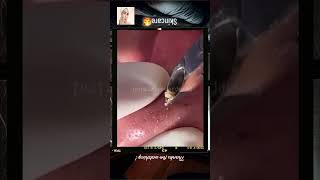 Blackheads Removal  Acne Treatment and Very Satisfying Satisfying Pimple pop blackheads [upl. by Carlock]