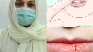 Cracked lipschapped lipsdryness dehydrated lips in URDUHINDI homeopathicmedicine Crackedlips [upl. by Weidman]