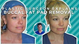 BUCCAL FAT PAD REMOVAL Surgery Recovery Before and After [upl. by Ailongam315]