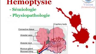 SÉMIOLOGIE et PHYSIOPATHOLOGIE de LHémoptysie [upl. by Pyne]