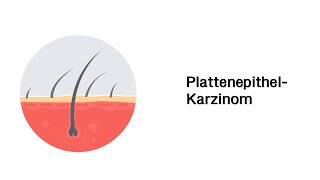 Plattenephitelkarzinom  Erkrankungen der Haut mit Infoleiste [upl. by Nnayram552]