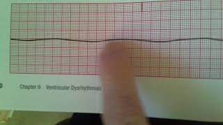 Agonal and Asystole [upl. by Mcgruter652]