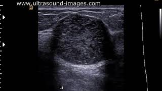 Phyllodes tumor ultrasound video [upl. by Kruse]