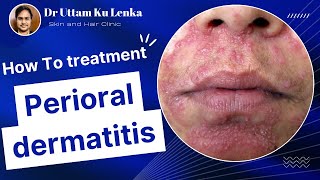 Perioral dermatitisAcne amp Rosacea Red rashes around mouth face me rashes ka karan druttam [upl. by Atsylak]