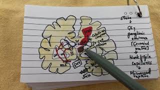 Germinal matrix hemorrhage grading  for exam going pg students [upl. by Cram711]