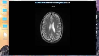 Haemosiderin staining brain MRI [upl. by Euqinahc]