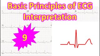 Basic Principles of ECG Interpretation  9 [upl. by Sillyrama]