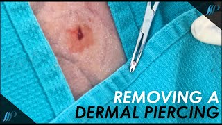 Getting a DERMAL PIERCING removed by a plastic surgeon [upl. by Wixted926]