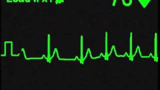 ECG Simulator  Sinus Rhythm with Baseline Wander [upl. by Selij]