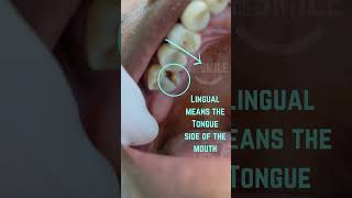 Broken tooth Removed dentist extraction verynicesmiledental [upl. by Griffin]