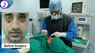 Rhinoplasty In Chennai  Rhinoplasty Surgery In Chennai  Nose Surgery  Zenith Clinic [upl. by Ainirtak740]