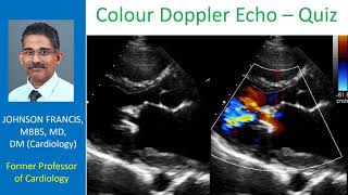 Colour Doppler Echo Quiz [upl. by Jenni]