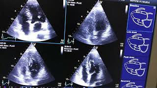 Digital Stress Echocardiography in LBBB [upl. by Chute152]