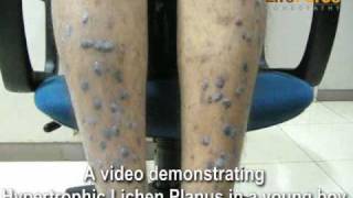 Young Boy with Hypertrophic Lichen Planus Spots on Legs [upl. by Boni]