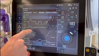 Het berekenen van de occlusie druk en predicted transpulmonaal druk ServoU [upl. by Labotsirhc]