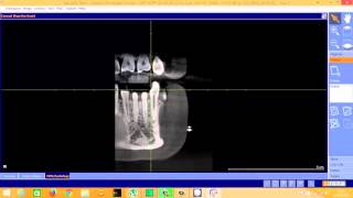 Sirona GalaxisGalileos Implant software  creating findings [upl. by Kwon3]