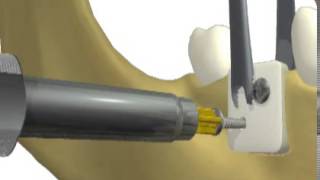 ACE truFIX Bone and Membrane Fixation System  Introduction [upl. by Giles163]