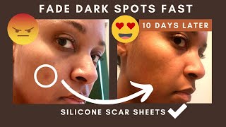 How to fade hyperpigmentation FAST with silicone SCAR SHEETS [upl. by Yedoc]