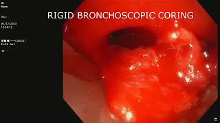 Central Airway Tumor  Rigid Bronchoscopy Tumor Debulking  Snaring  Cryoextraction [upl. by Tedder]