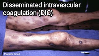 Disseminated intravascular coagulation  DIC  causes symptoms pathologydiagnosis treatment [upl. by Eustache]