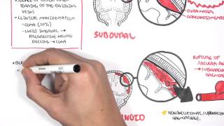 Intracranial Haemorrhage Types signs and symptoms [upl. by Corrine]