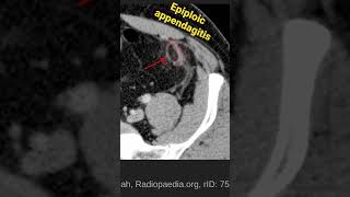 Epiploic appendagitis [upl. by Solitta]