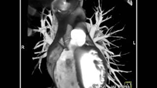 Post cardiac surgery with cut thru heart imaging [upl. by Asinla90]