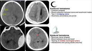 Emergency Neuroradiology Session 1 Spontaneous ICH amp Brain Aneurysms [upl. by Iruj]