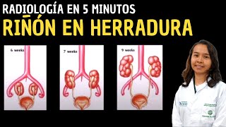 Radiología en 5 minutos Riñón en herradura [upl. by Esidarap]