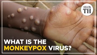 What is the monkeypox virus  The Hindu [upl. by Joey214]