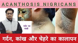 गर्दन कांख और चेहरे का कालापन  गर्दन पर मस्से  Acanthosis Nigricans skintag acanthosisNigricans [upl. by Willy14]