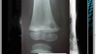 OSTEOMYELITE AIGUE DE LENFANT Dr M DJELAD [upl. by Yleve993]