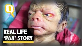 The Quint Progeria Child In Bangladesh [upl. by Pier]