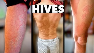 HIVES EVERYWHERE What Caused This Allergic Reaction  Dr Paul [upl. by Littman12]