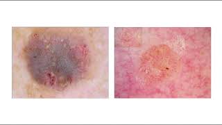 Tema 9 Dermatoscopia de la queratosis seborreica [upl. by Faustina]