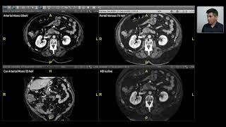 Spectral Imaging  Pancreas [upl. by Aij]