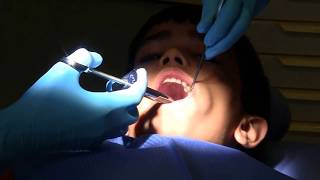 Tooth filling in school dental clinic Part 2 Tooth filling [upl. by Gib]