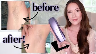 I tried laser hair removal at home this is what happened [upl. by Maxentia]