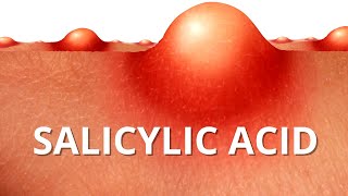 Heres WHY Salicylic Acid is Best For ACNE [upl. by Roxanne]