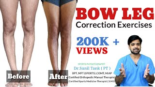 Bow Legs Correction Exercises in hindi  Bow leg correction at home  How to fix bowed legs [upl. by Argela]