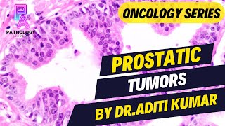 PROSTATIC TUMORS EXPLAINED  By Dr Aditi Kumar [upl. by Ahtimat]