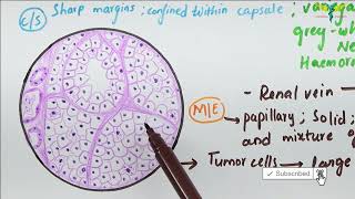 Histopathology of Renal Cell Carcinoma [upl. by Ibob361]