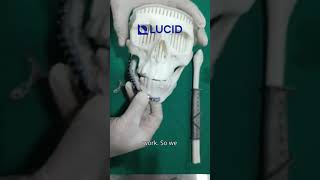 Guided Mandible Resection amp Reconstruction using Fibula Free Flap amp CustomMade Titanium Implant [upl. by Udella]