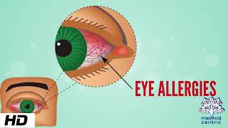 Eye Allergy Causes Signs and Symptoms Diagnosis and Treatment [upl. by Anidnamra]